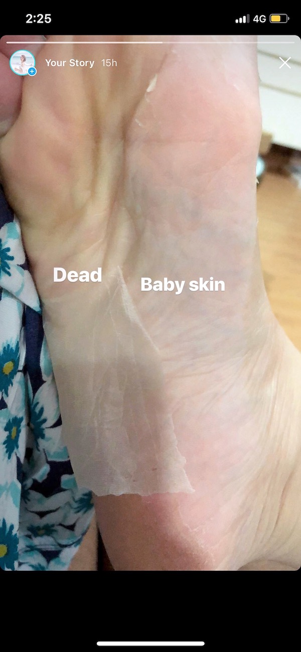 How Often Should You Use Baby Foot Peel Baby Viewer