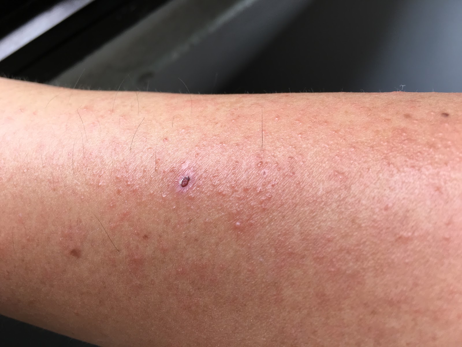 super-itchy-rash
