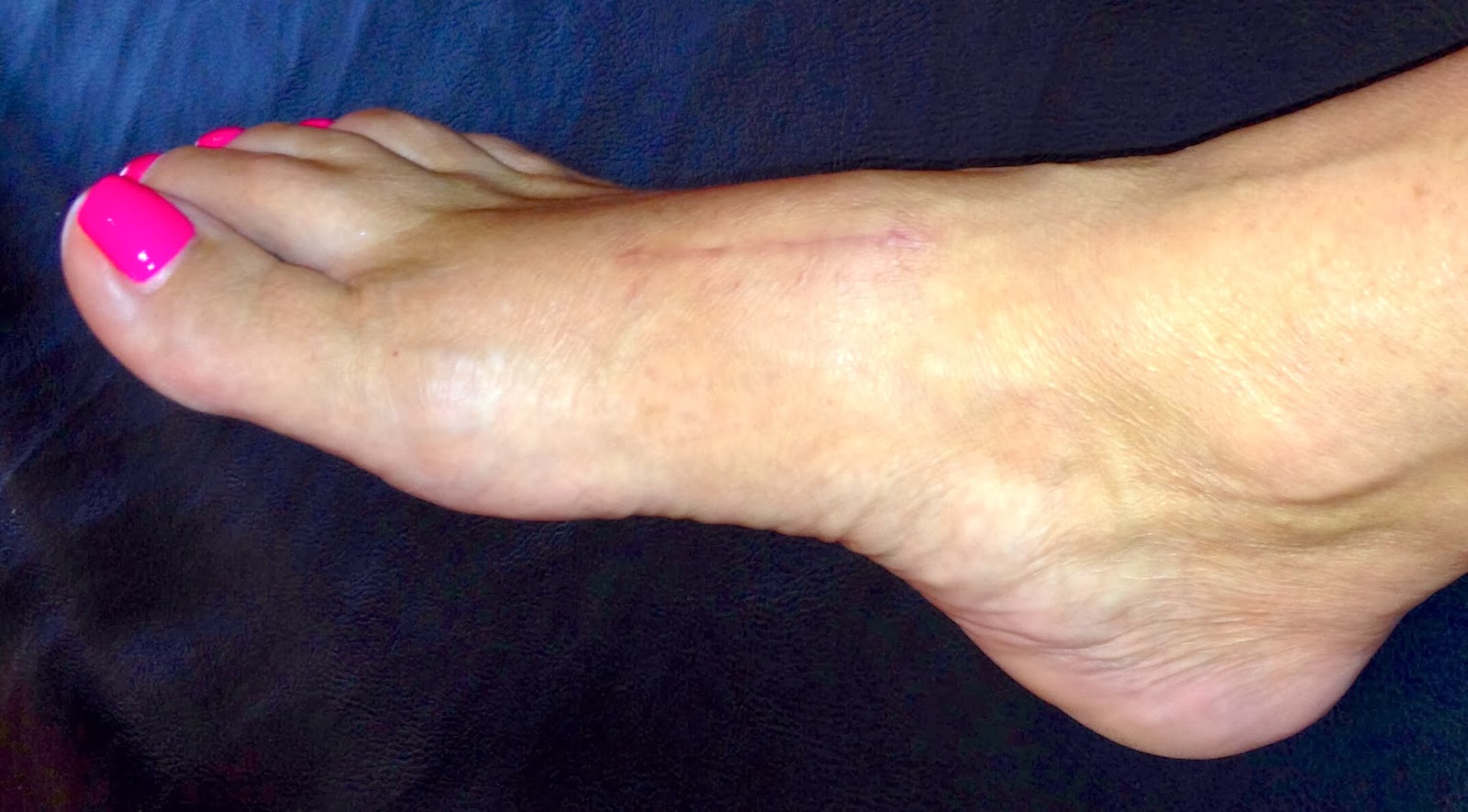 After LisFranc Surgery