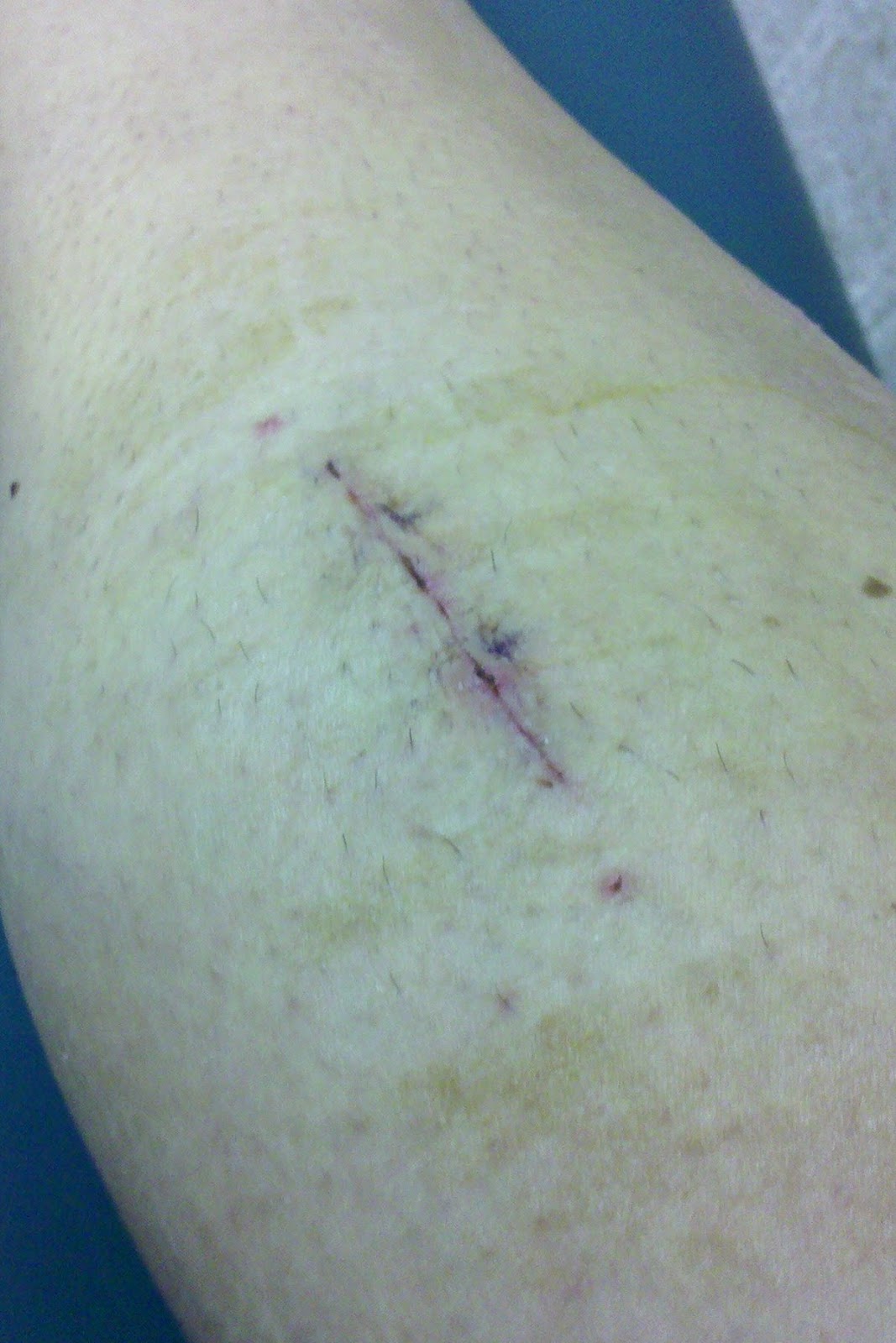 My Experience with Chronic Exertional Compartment Syndrome My Progress