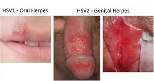 obat untuk herpes bibir