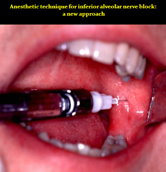 PDF Anesthetic technique for inferior alveolar nerve block a new