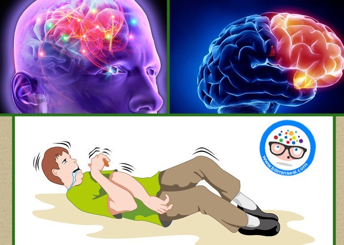 Санатории эпилепсия. Эпилепсия мозг. Мозг эпилептика. Эпилепсия иллюстрация.