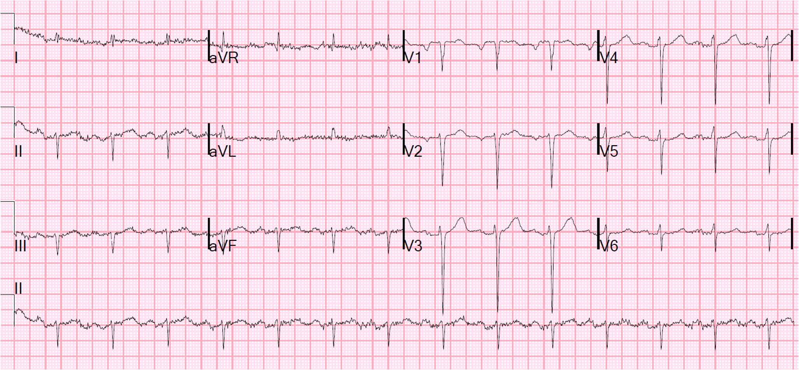 Dr. Smith's ECG Blog Tachycardia with Pericardial Effusion