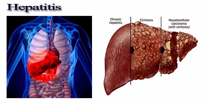 Острый гепатит с (огс) у детей. Человек с гепатитом б. Синдром жильбера ксантомы. Человек с гепатитом б. Алкогольный гепатит желтушность.