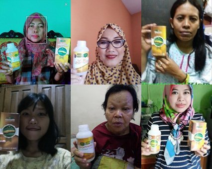 Cara Mengobati Cantengan Parah Bernanah dan Akut Secara Alami Cara Mengobati Cantengan Parah Bernanah dan Akut Secara Alami