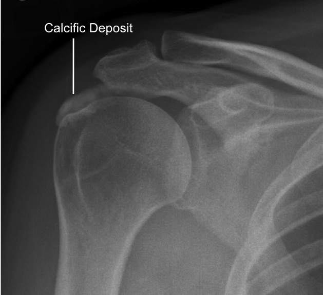 Myofascial Bodywork Calcific tendonitis aka intense shoulder pain!
