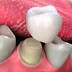 Bọc răng sứ thẩm mỹ là gì ?
