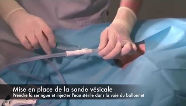 Calcul Volume Vésical – FICHE INFO PATIENT – ILOC