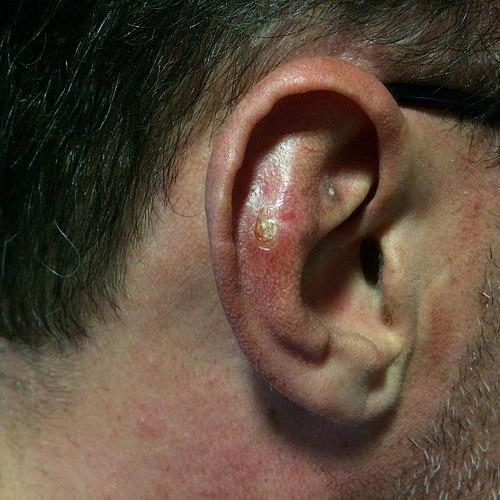 سرطان-الأذن