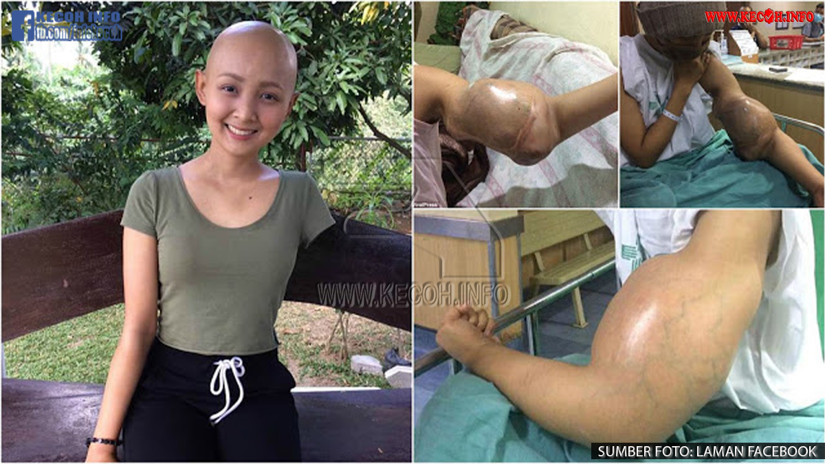 ''Ingatkan Bekas Gigitan Nyamuk, Rupanya Kanser Bila Tangan Bengkak Tiba-Tiba'', Lengan Gadis Ini Terpaksa Dipotong ''Ingatkan Bekas Gigitan Nyamuk, Rupanya Kanser Bila Tangan Bengkak Tiba-Tiba'', Lengan Gadis Ini Terpaksa Dipotong