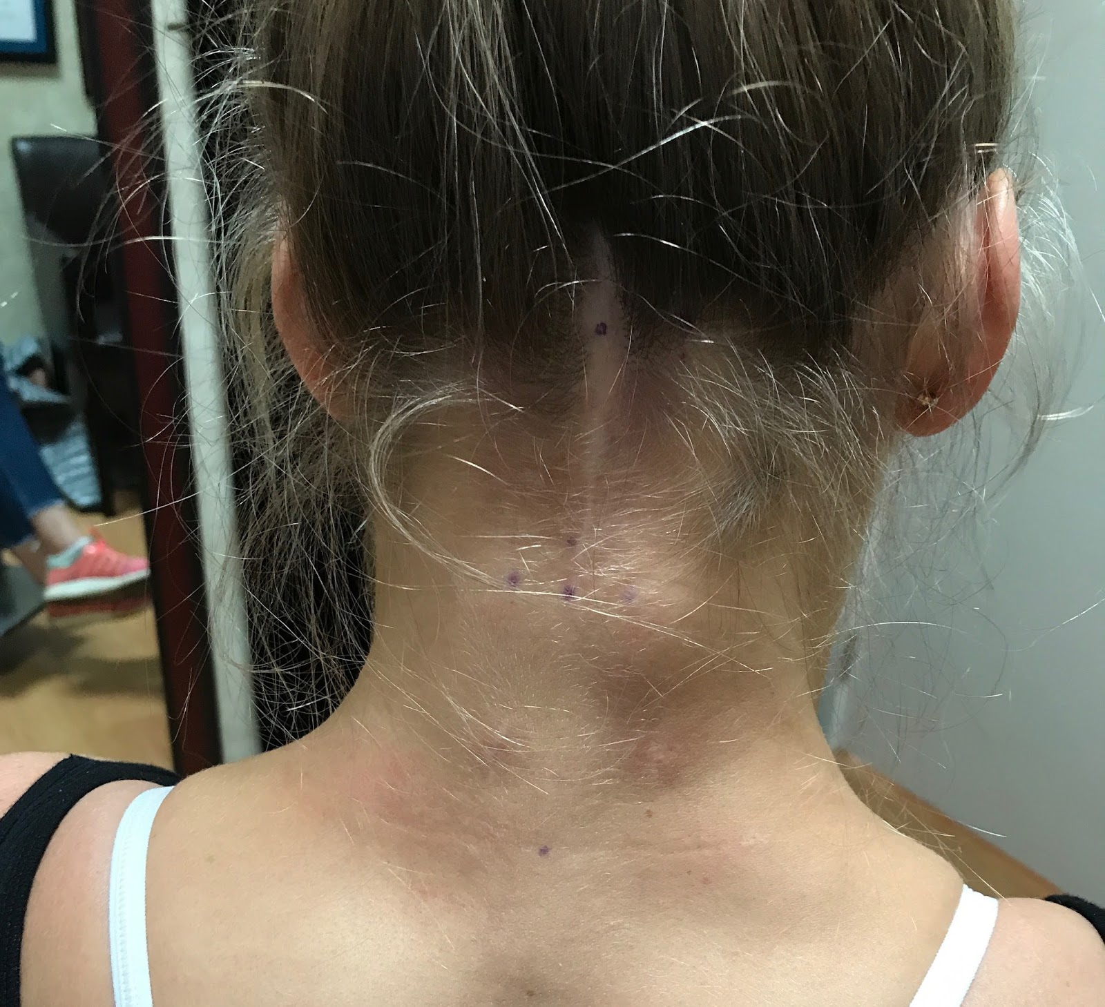 ...but maybe tomorrow occipital nerve surgery tomorrow!