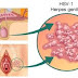 Ciri Ciri Herpes Genitalis Pada Wanita dan Pria|Obat Herpes