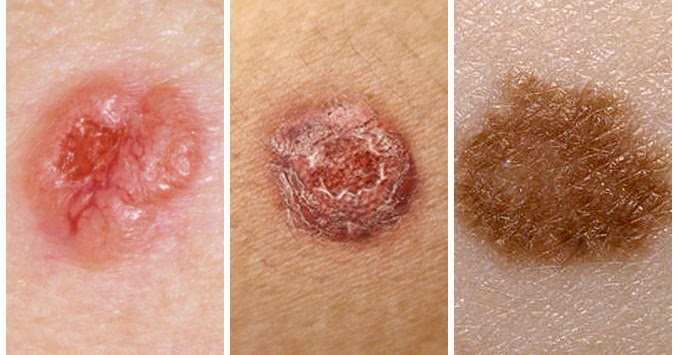 Types de cancer de la peau - Symptômes du cancer de la peau