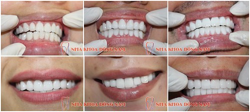 LÀM RĂNG SỨ HAI CÁI RĂNG CỬA LÀ BAO NHIÊU TIỀN -1