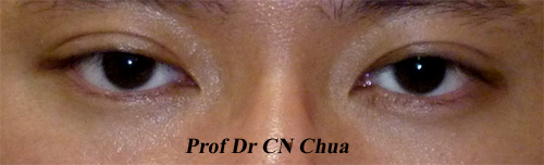 Eyelid Surgery by Prof Dr CN CHUA 蔡鐘能: Case 5: Doctor, Why Are My ...