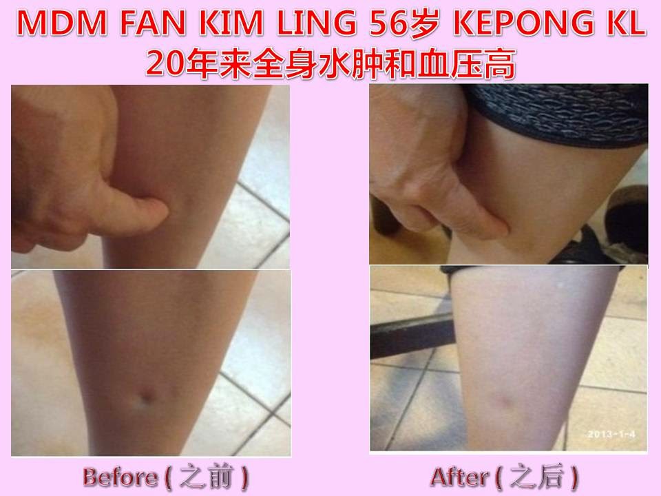 MDM FAN KIM LING (56) KEPONG KL-20 YEARS WATER RETENTION WHOLE BODY & HYPERTENSION