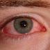 3 Remedios Caseros Para La Conjuntivitis