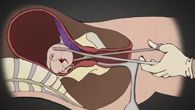 guncel olmayan blog probe kurtaj nedir
