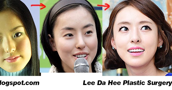 Plastic Surgery Examples Lee Da Hee Before And After 이다희 성형 수술