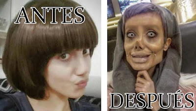 Mujer iraní se sometió a 50 cirugías para parecerse a Angelina Jolie y terminó pareciendose a un zombie