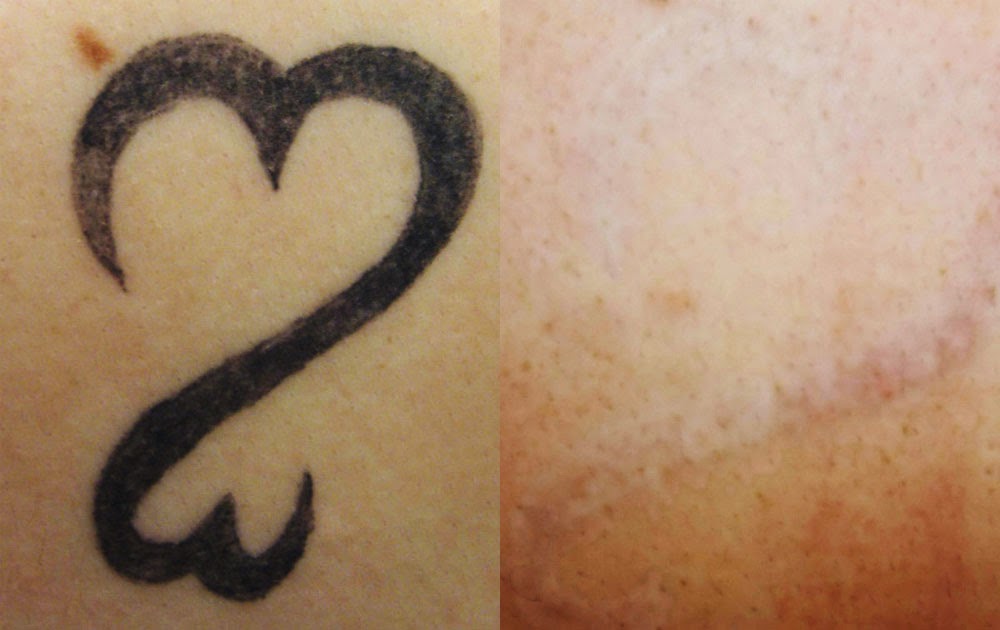 ... , Laser Skin Toning, Birthmark &amp; Tattoo Removal With Medlite C6 Laser