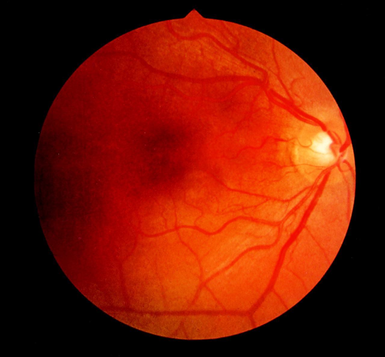 День сетчатки. Пигментный ретинит сетчатки. Атипичный пигментный ретинит. Пигментного ретинита (абиотрофии сетчатки.