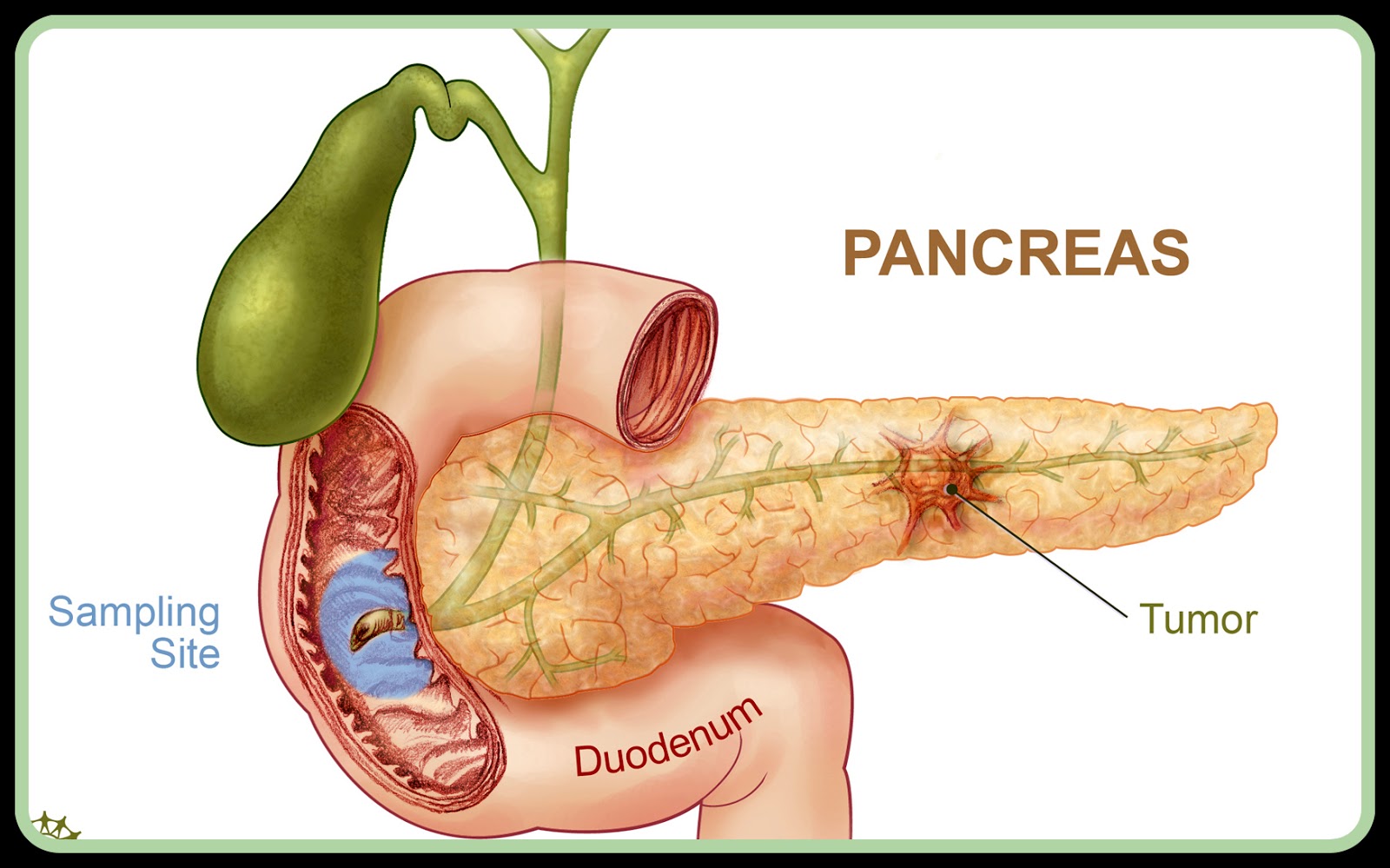 5 Info Ringkas Kanser Pankreas Dmanje Spa Bangi