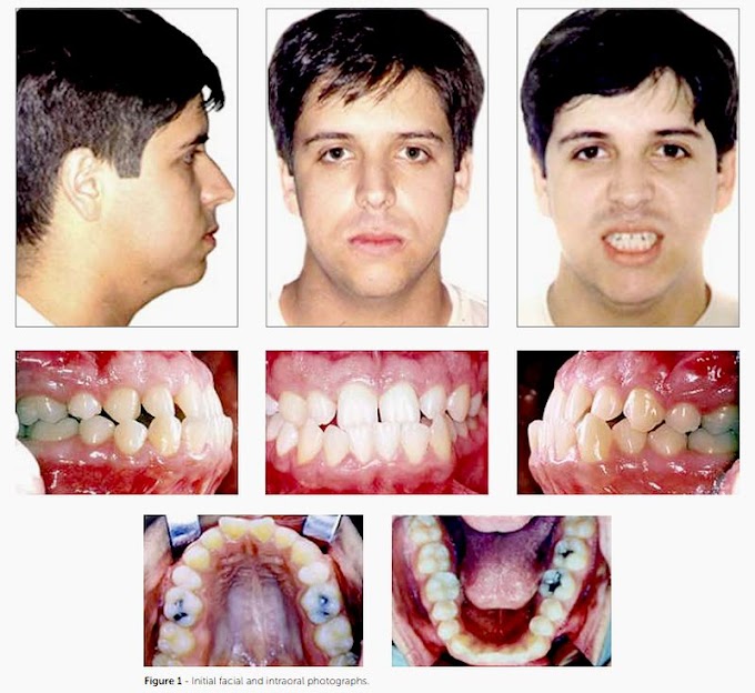 PDF: Compensatory orthodontic treatment of skeletal Class III malocclusion with anterior crossbite