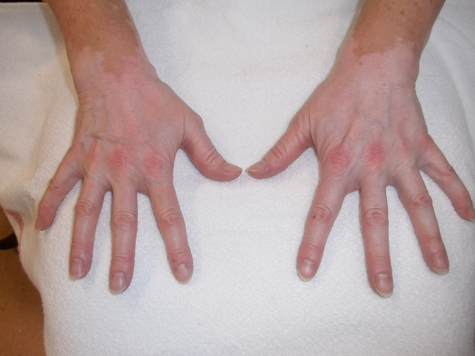 Rheumatologe Vitiligo in a Patient with Rheumatoid Arthritis under