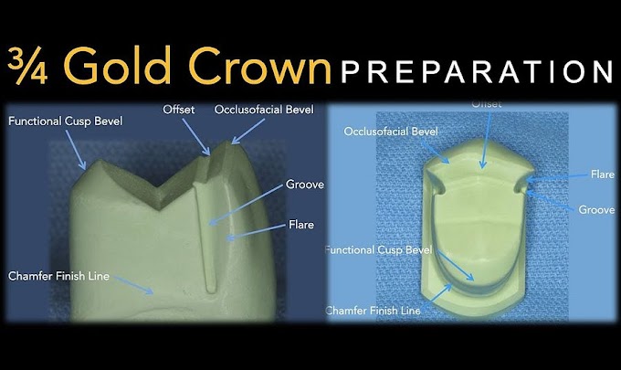 PROSTHODONTICS: 3/4 Gold Crown Preparation - Dr. Richard Stevenson