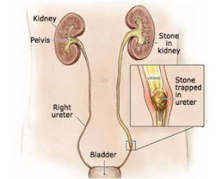 Use of Alpha 1 blocker as a part of Medical Expulsive Therapy (MET) for