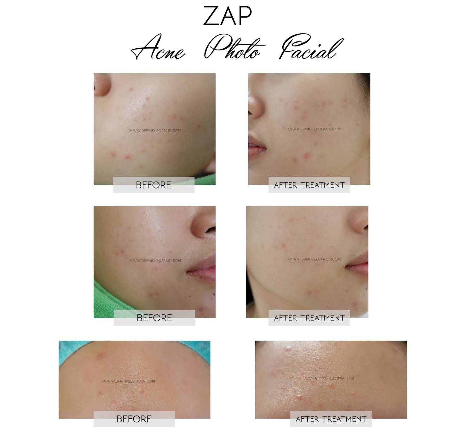 [REVIEW] Treatment Photo Facial Acne di ZAP Clinic Sprinkle of Rain