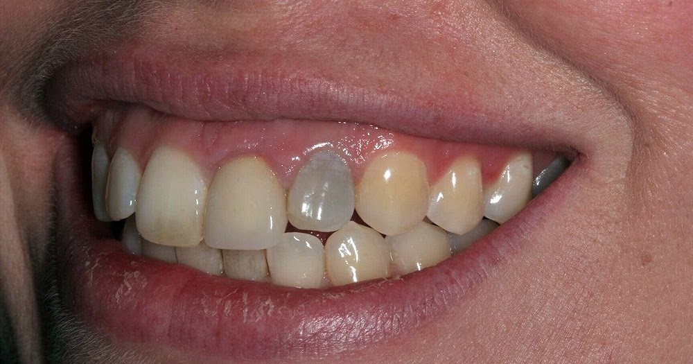 Why Is My Tooth Turning Gray? Directorio Odontológico