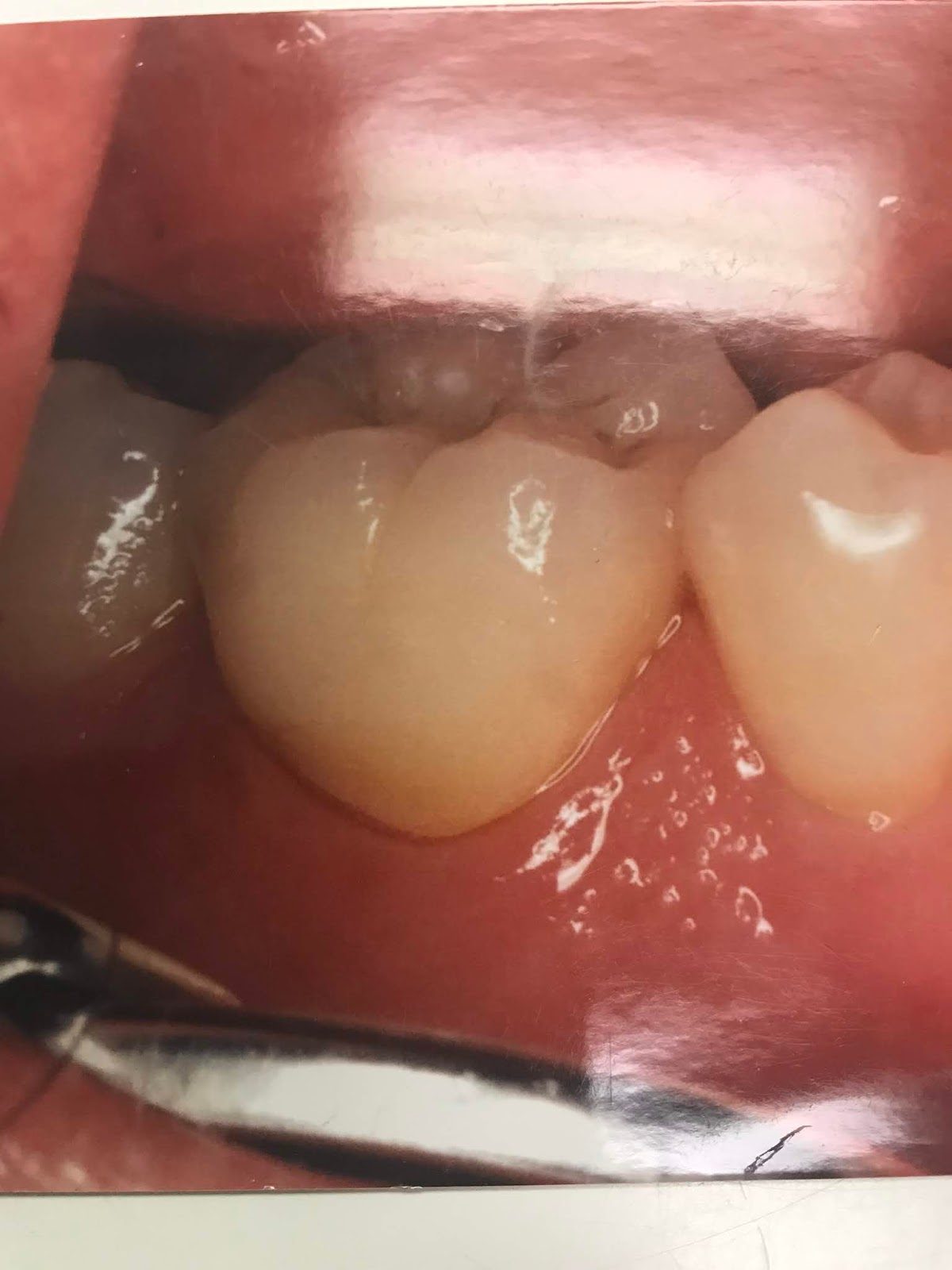 Ask Dr. Spindel Why does my tooth need a crown?