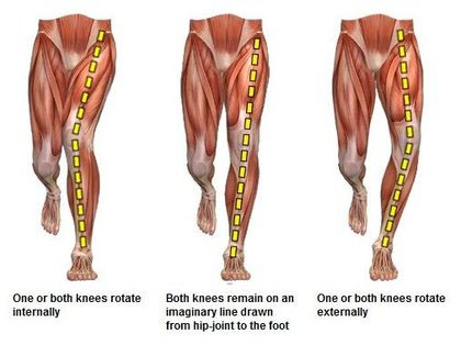 Knee valgus is as valgus collapse and medial knee displacement. It is characterized by hip adduction and hip internal rotation, usually when in a ...