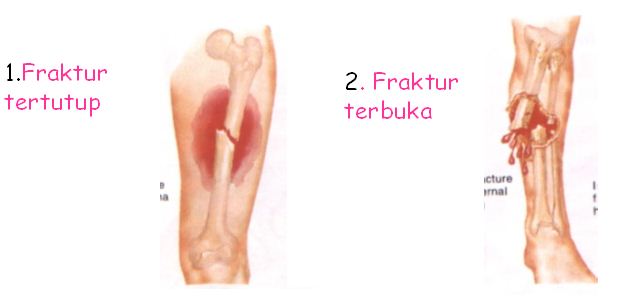 Penyakit Gangguan Dan Kelainan Pada Sistem Gerak Insan Beserta Gambarnya