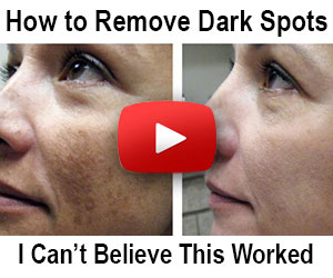 Beverly Hills MD – Dark Spot Remover