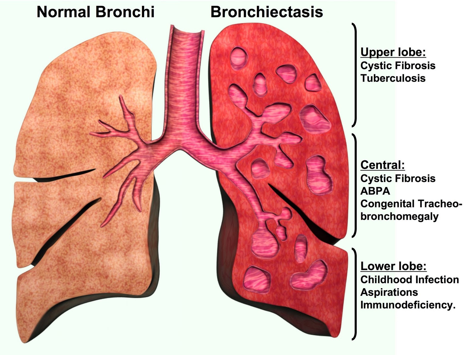 Врожденный туберкулез. Бронхоэктатическая астма. Бронхоэктатическая болезнь. Врожденные бронхоэктазы. Бронхоэктатическая болезнь легких.