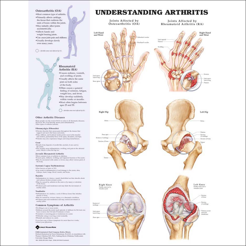 Rheumatoid Arthritis and Its Effects on Todays
