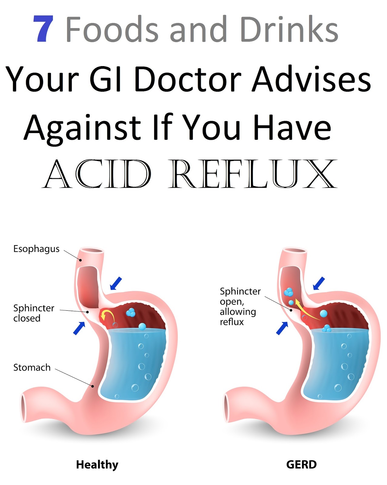 7 Foods and Drinks Your GI Doctor Advises Against If You Have Acid