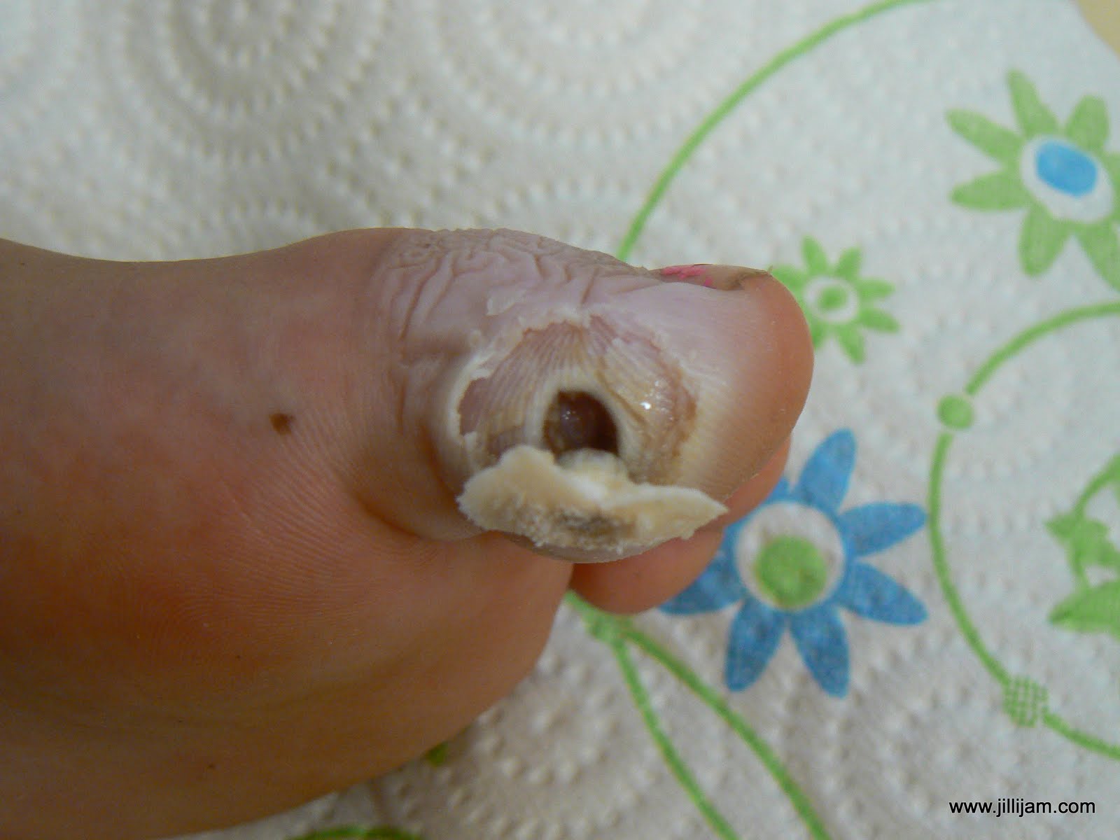 plantar wart on toe pictures