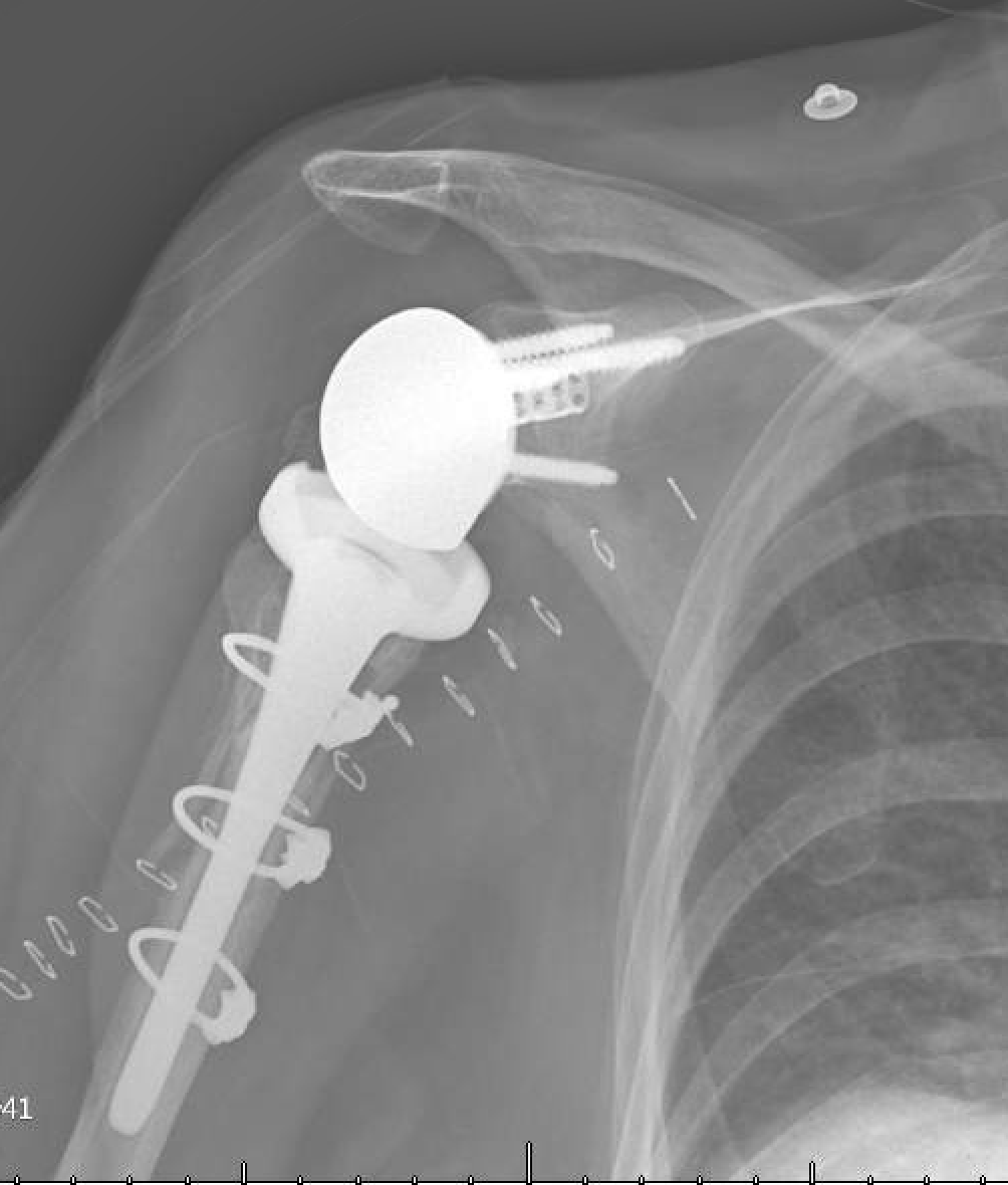 Shoulder and Elbow Surgery Revision of failed cemented
