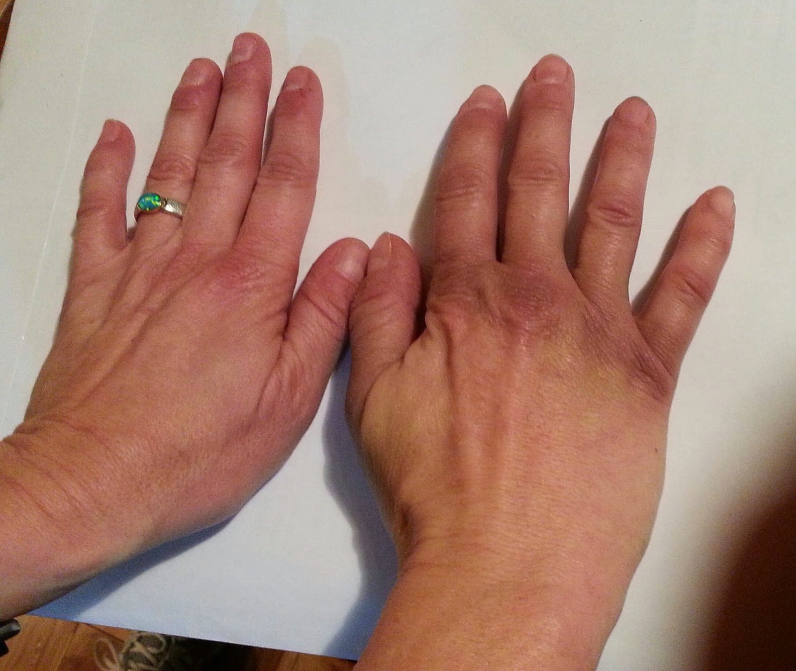 Albums 95+ Pictures pictures of bruising after carpal tunnel surgery Stunning