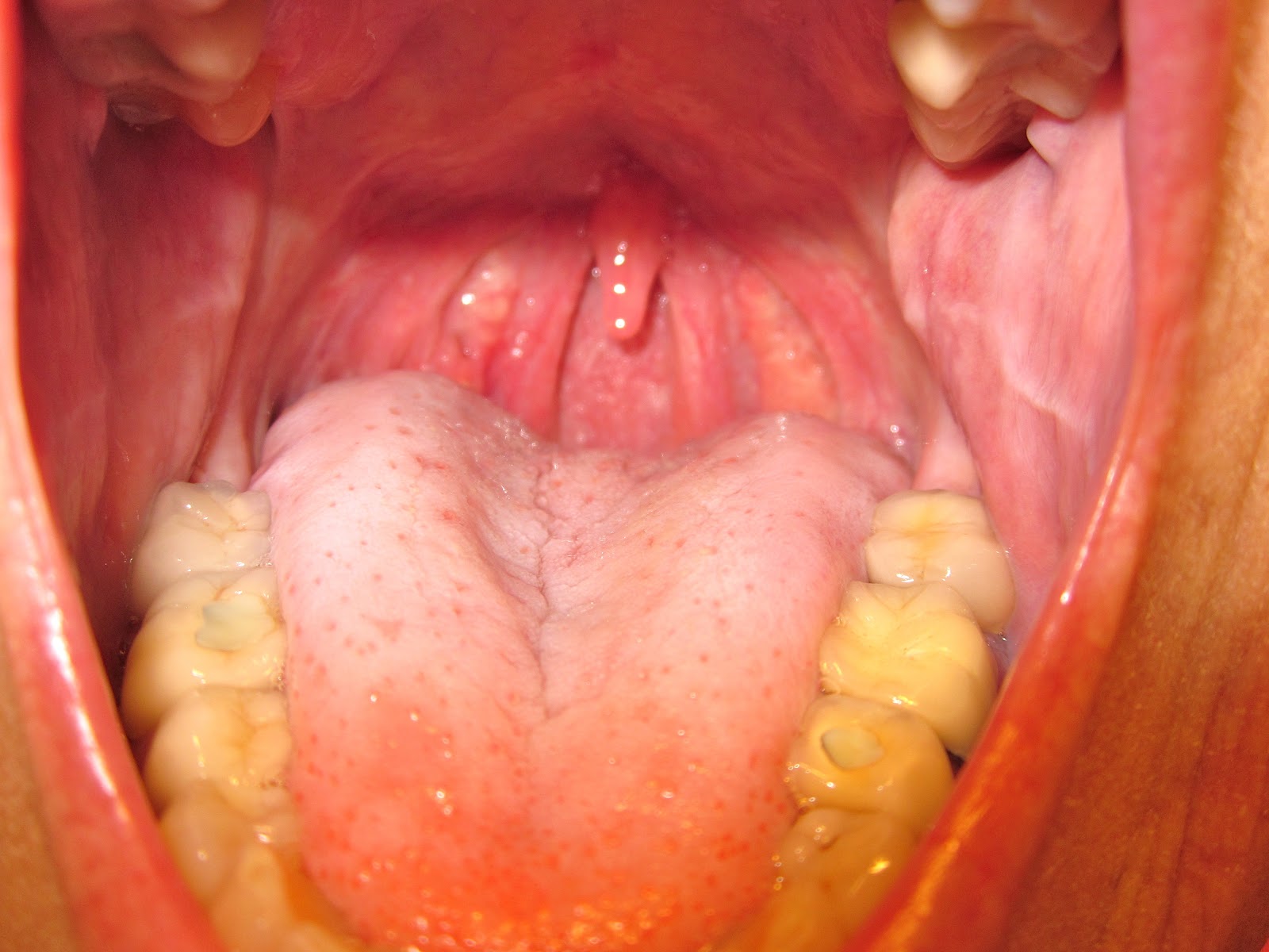 Blisters In Back Of Throat Singles And Sex