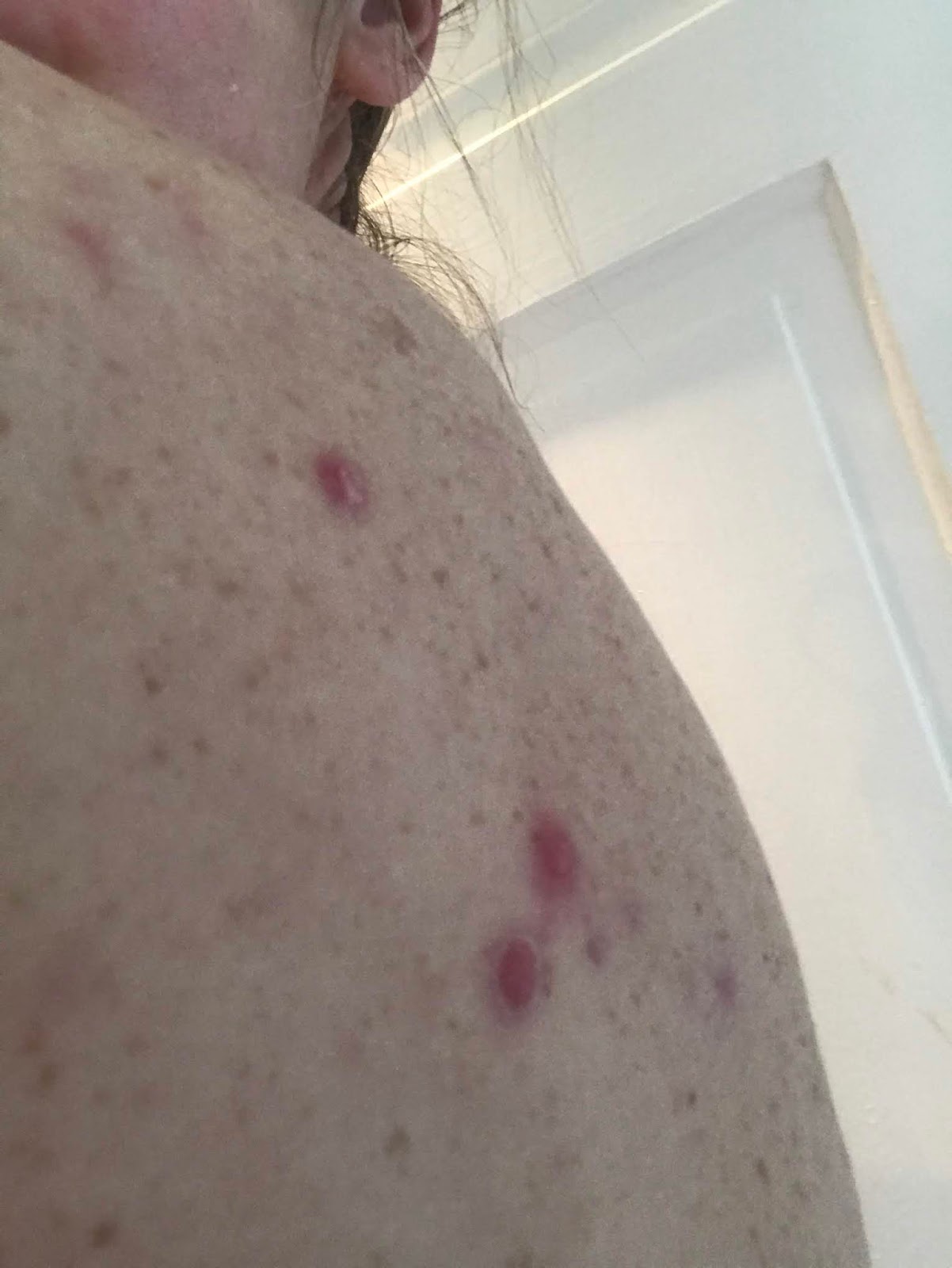 Acne on left shoulder before diet and homeopathy
