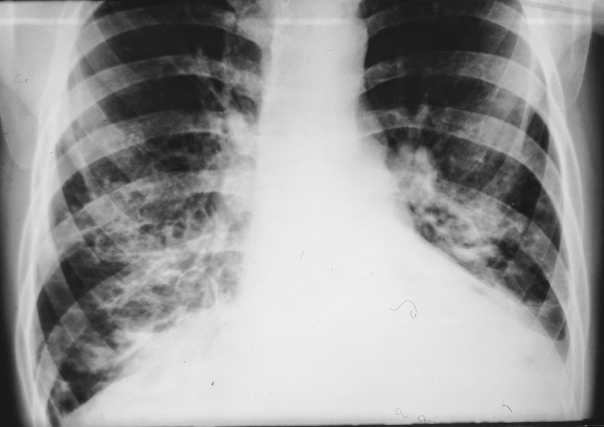 Бронхиальная астма рентгенологическая картина
