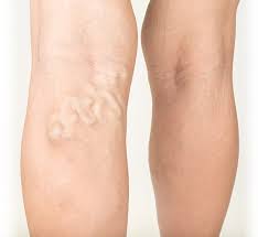 Top 5 Remedies for Varicose Veins