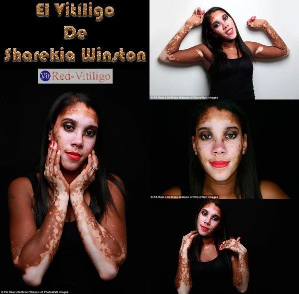 Personas con Vitiligo │ Sharekia Winston.