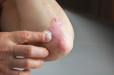 psoriasis en los codos